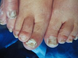 银屑病症状